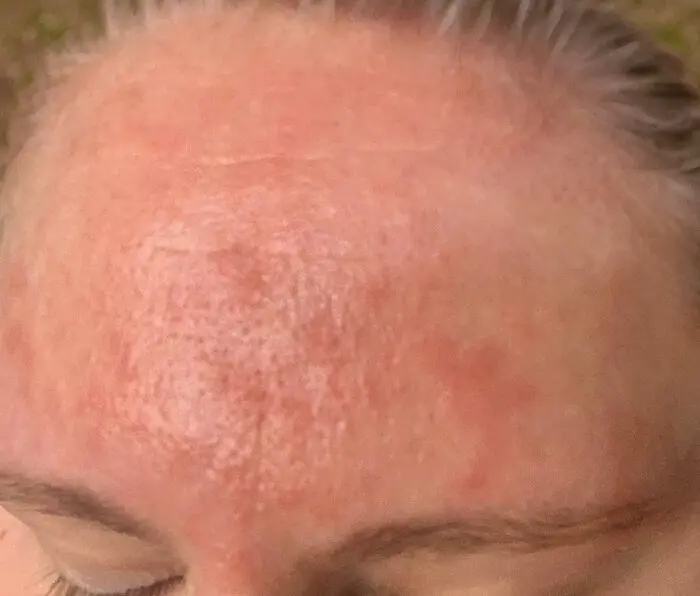 Tretinoin Damaged Skin Barrier from not wearing sunscreen