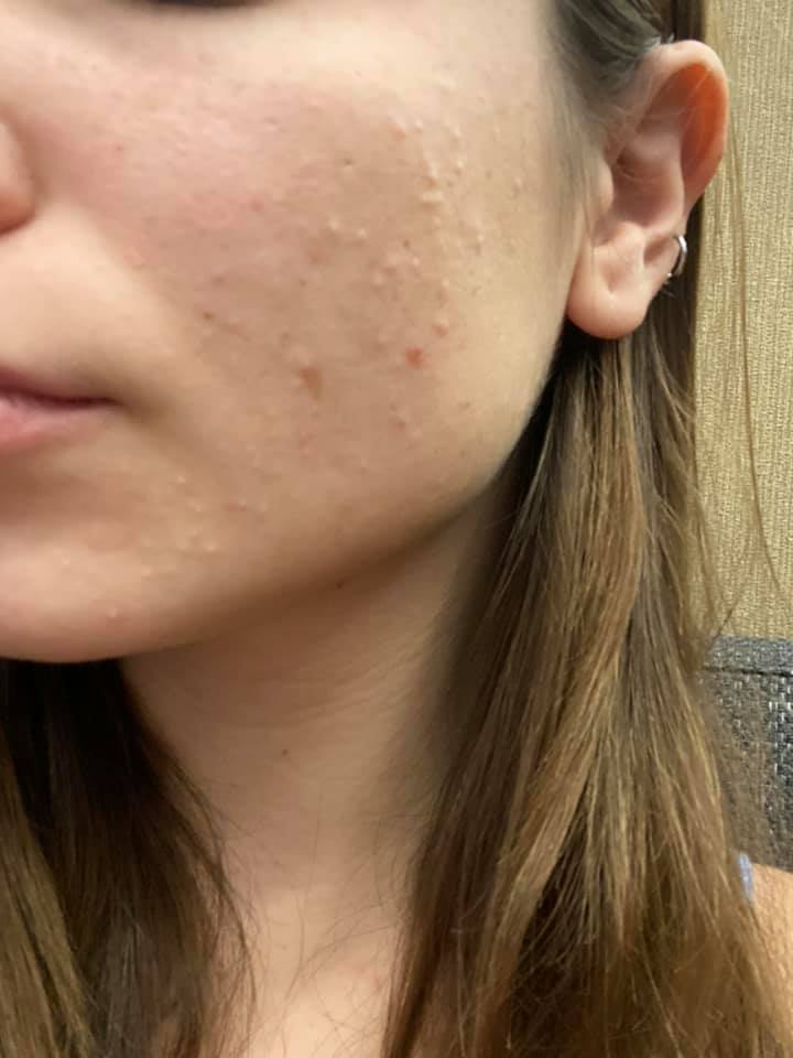 What does the tretinoin purge look like