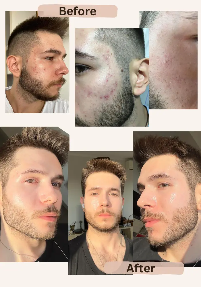 tretinoin purge before and after