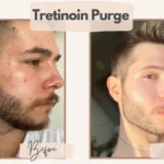 Tretinoin Purge - How long do retinol uglies last?