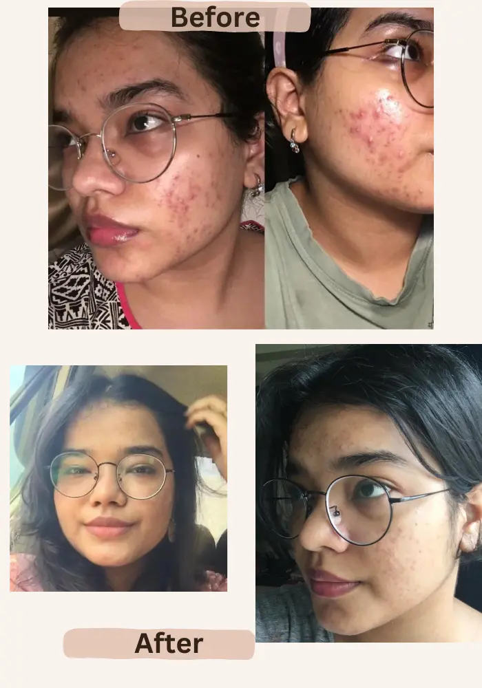 tretinoin purge before and after