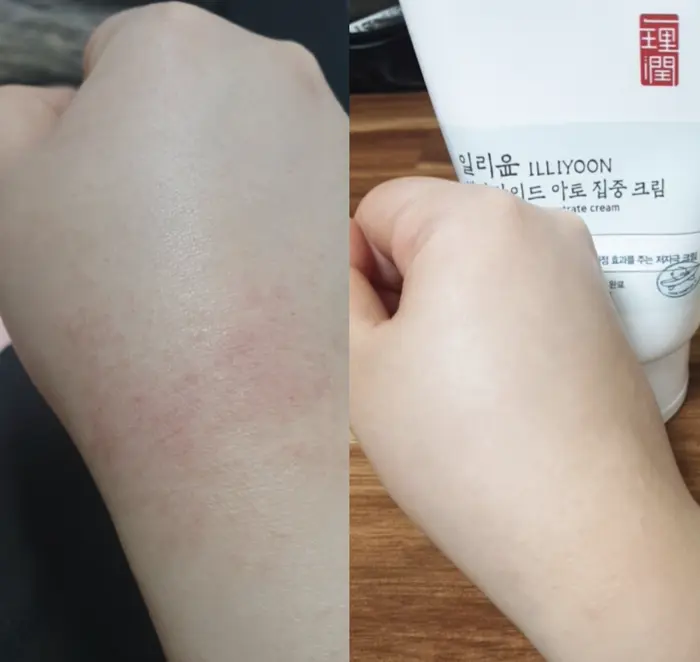 ILLIYOON Ceramide Ato Concentrate Cream eczema before and after