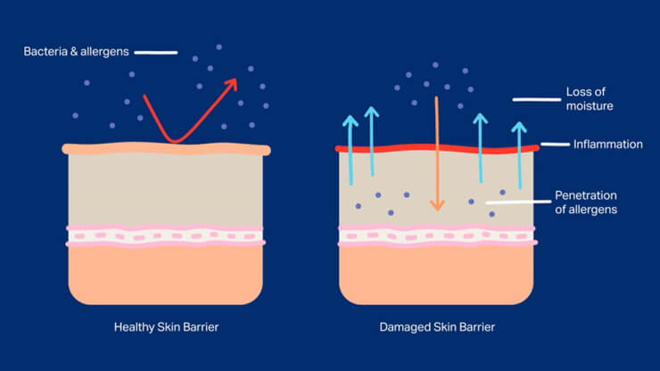 healthy skin barrier vs damaged skin barrier