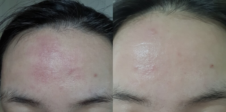 real barrier extreme cream eczema before & after