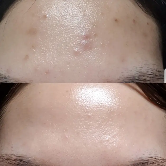 Cosrx AHA/BHA Clarifying Treatment Toner before after forehead